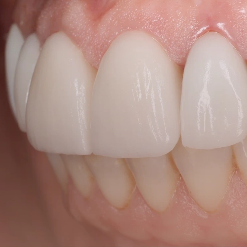 Facetas dentárias para estética do sorriso