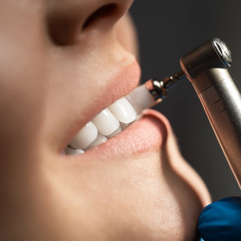 Imagem ilustrativa de limpeza dentária