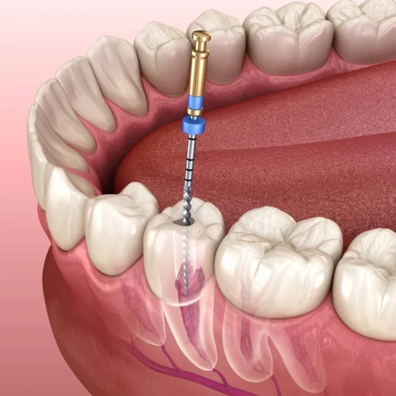 Tratamento de canal (endodontia) para dor de dente