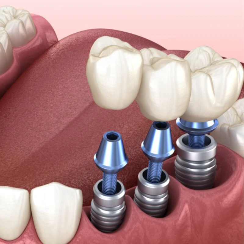 Implante dentário para reposição de dentes perdidos