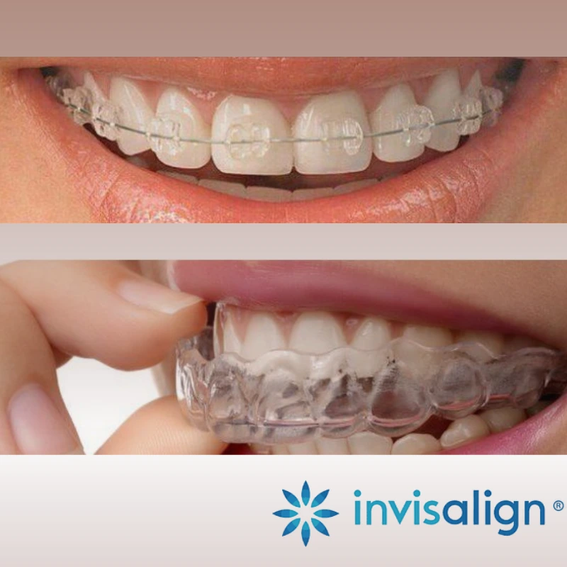 Tratamento ortodôntico com aparelhos dentários